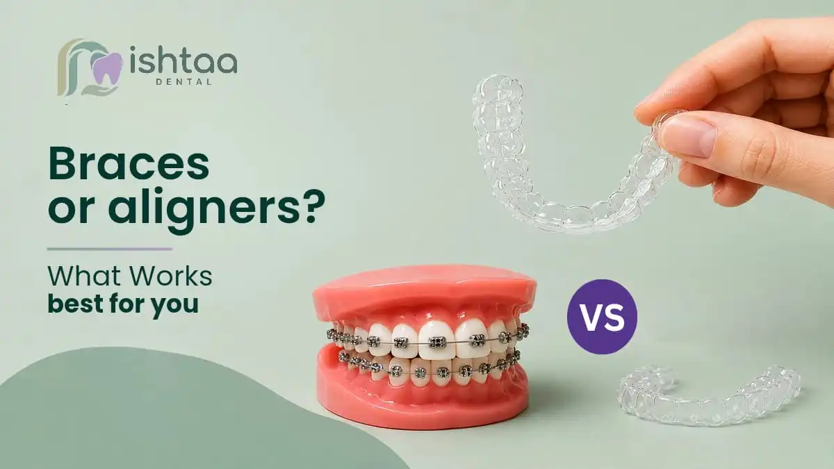 braces-aligners