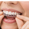 Wear & Change Aligners
