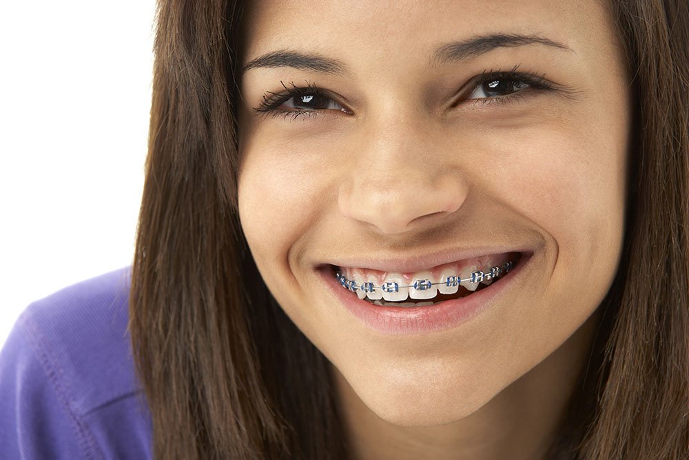 Braces Treatment in Shilaj and South Bopal, Ahmedabad