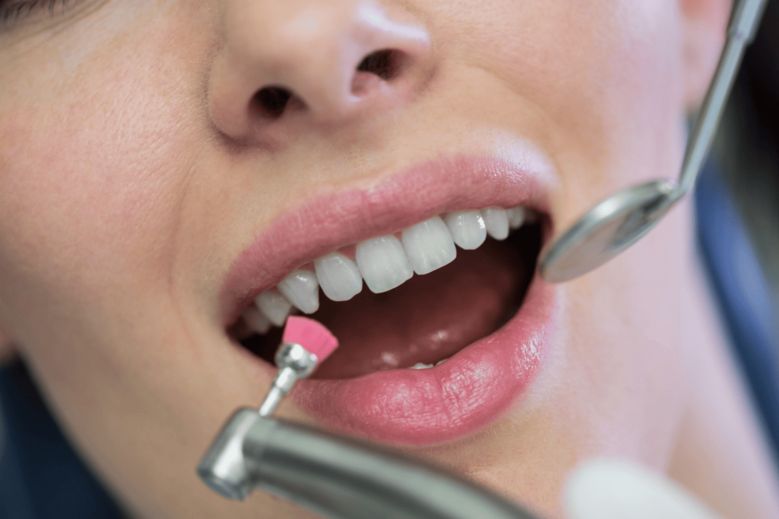 Teeth Cleaning and Whitening in Shilaj & South Bopal, Ahmedabad