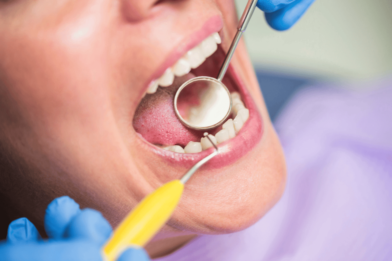 Tooth Filling in Shilaj and South Bopal, Ahmedabad
