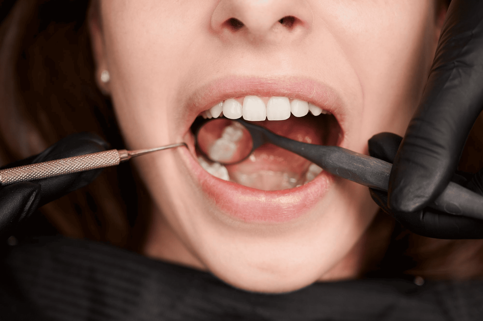 Wisdom Teeth Removal in Shilaj & South Bopal, Ahmedabad