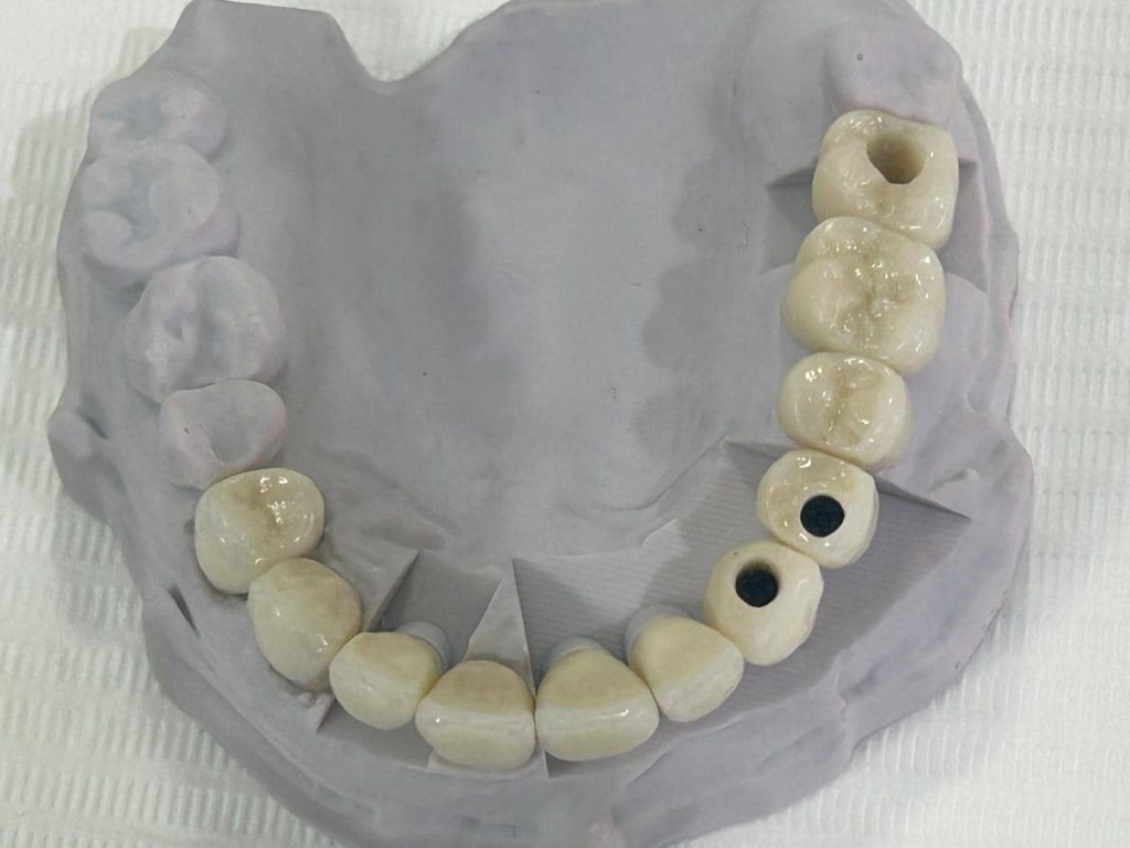 Full mouth rehabilitation dental model