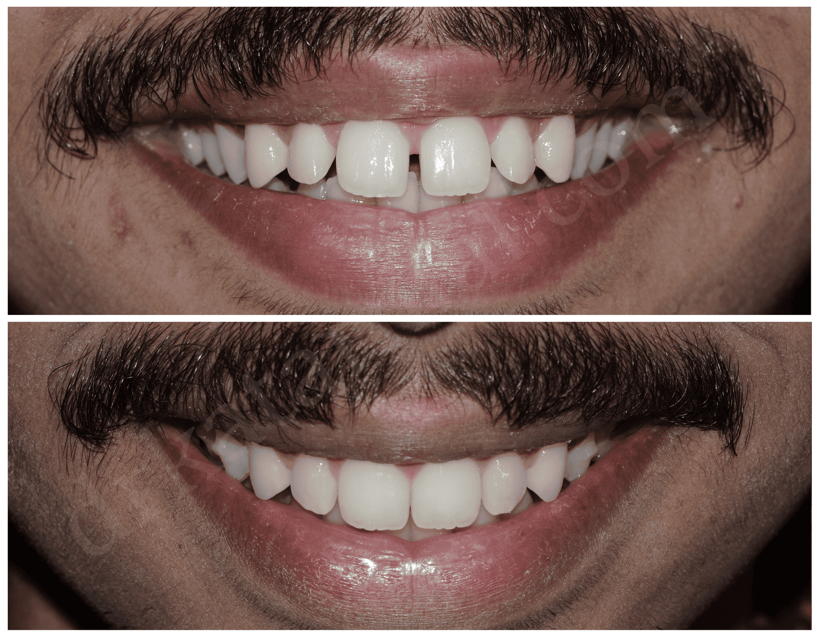 Smile Makeover
