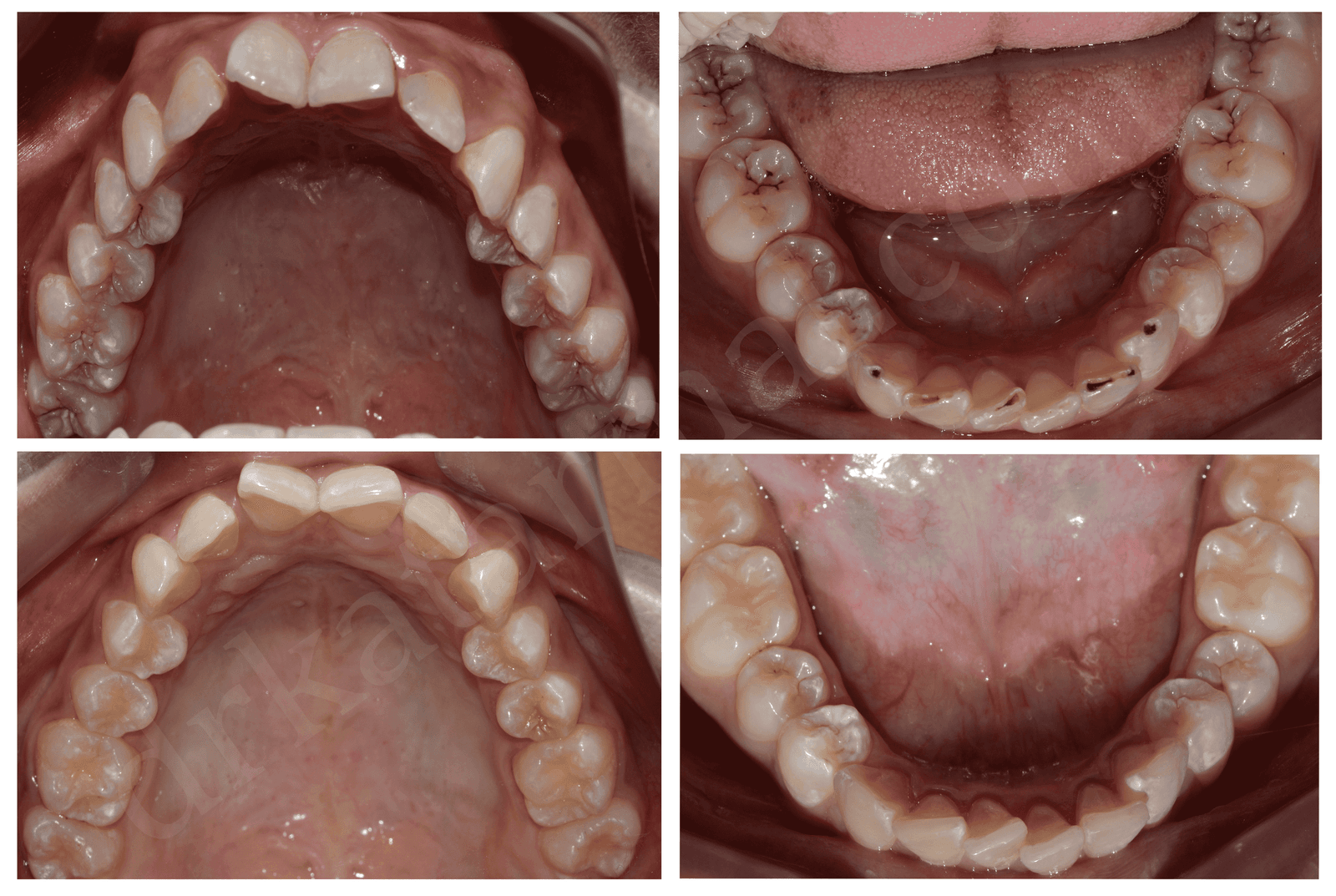 Smile Makeover