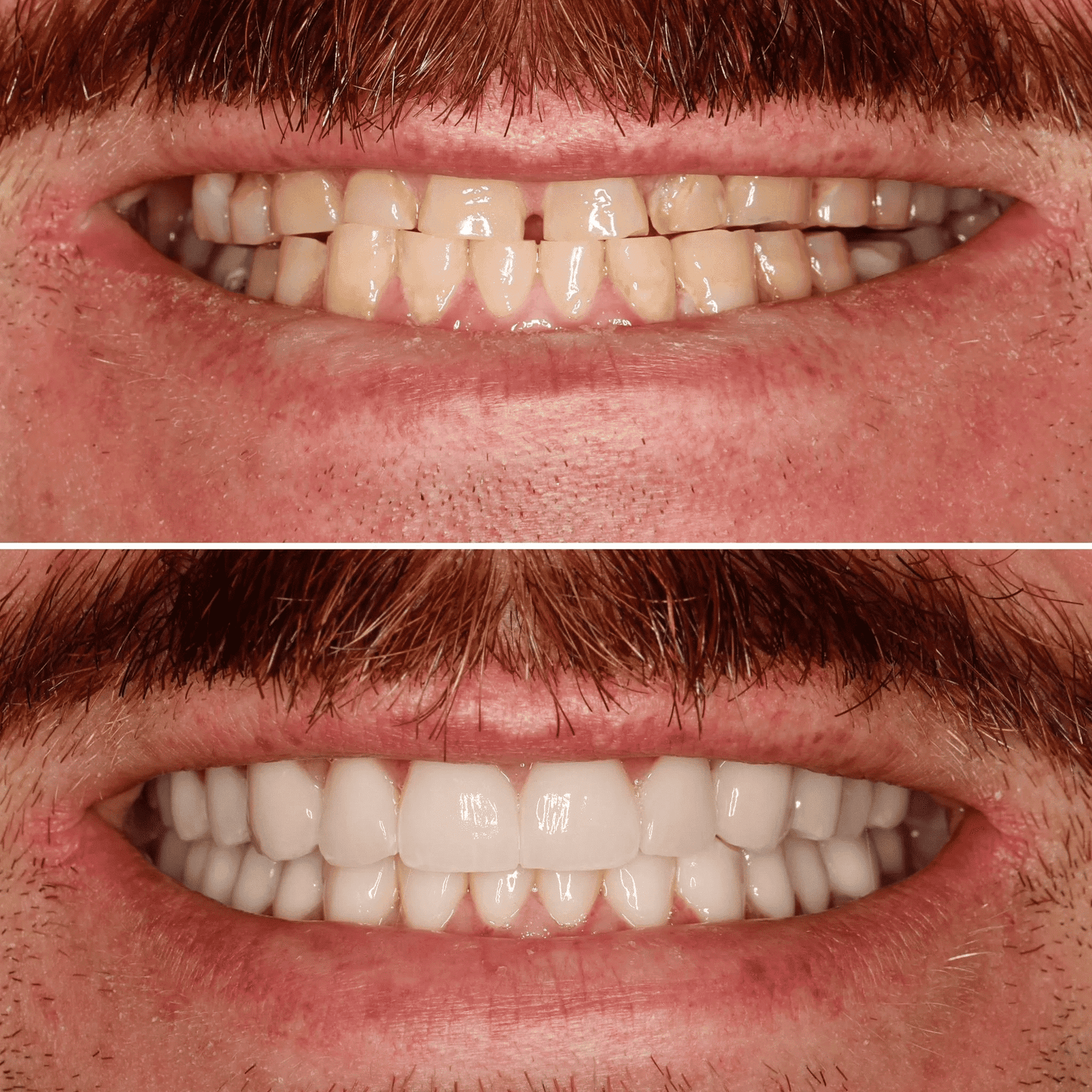 Smile Makeover