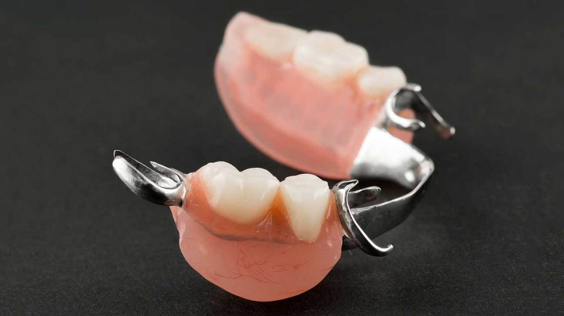 Removable Partial Denture